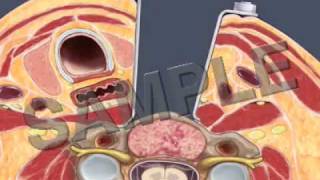 Anterior Cervical Fusion 3D2D Medical Animation [upl. by Anaud]