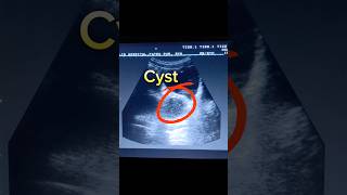 Hemorrhagic Cyst Ovary  Adnexal Cyst  Cyst with internal echoes and Septations  Ovarian Cyst [upl. by Anauqed]