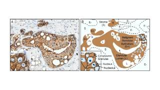 XMRV a New Human Retrovirus Lecture 25 [upl. by Bonnee]