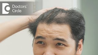 How to treat hair thinning in front part of the scalp  Dr Nischal K [upl. by Suivatnom]