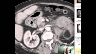 CT Abdomen and Pelvis anatomy DISCUSSION [upl. by Eneleoj]