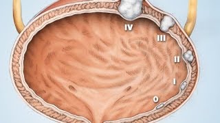 Rak pęcherza moczowego leczenie [upl. by Aneet]