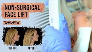 3 Ways To Get A Facelift Without Surgery  FAST and EASY Solution [upl. by Gruchot936]