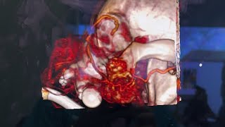 Ct review for maxillectomy orbitectomy taking place soon [upl. by Asilam]