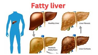 fatty liver Non Alcoholic FattyLiverDisease Liver Awareness Health Education [upl. by Bibbie]