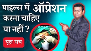 पाइल्स में ऑप्रेशन करना चाहिए या नहीं  पूरा सच when do piles need surgery piles pilesclinic [upl. by Hamburger799]