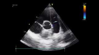 Diastolic flow in the pulmonary artery coronary fistula echo [upl. by Daniela]