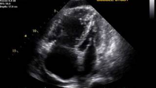 Pulmonary Hypertension echo [upl. by Elayor143]