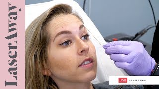 Xeomin Treatment LIVE SESSION at LaserAway 🔴 [upl. by Miner806]