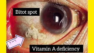 Bitot Spot  Vitamin A Deficiency  Dr Shahans Class [upl. by Christiane355]