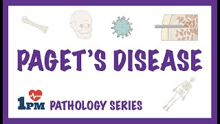 Pagets Disease  Pathology Causes Symptoms Diagnosis Treatment [upl. by Niatsirk957]