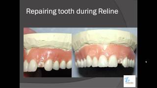 Closed Flask Denture Reline Technique [upl. by Steffy]