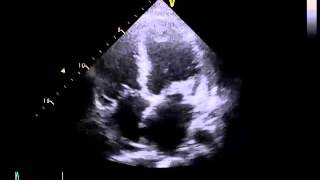 Echocardiography to Assess MitralValve Leaflets  NEJM [upl. by Tsirhc]