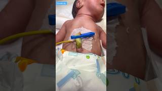 Umbilical Cordnewbornbaby viralvideo [upl. by Akirdnwahs]