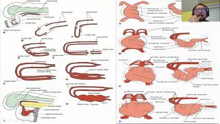 Ventricular Septal Defect [upl. by Eran82]