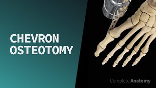 Chevron Osteotomy [upl. by Notaek]