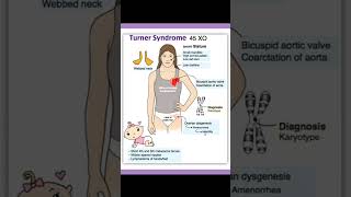 Turners syndrome [upl. by Gerg107]