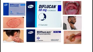 Diflucan tablet  Uses  Side effects  HindiUrdu [upl. by Stochmal]