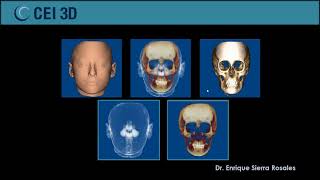 Webinar Planificación para Implantes con Tomografía Cone Beam [upl. by Germana]