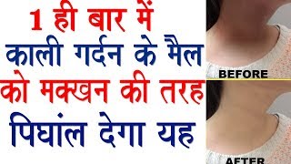 1 ही बार में काली गर्दन के मैल को मक्खन की रह पिंघाल देगा  काली गर्दन गोरी हो जाएगी Neck Whitening [upl. by Eduino]