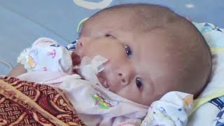 Parents Pray for Miracle After Their Baby Is Born With 2 Faces [upl. by Eyak]