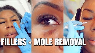 BLACK EYE DISSOLVING TEAR TROUGHS FILLER  LASER MOLE REMOVAL [upl. by Krall374]