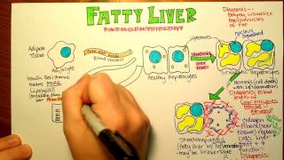 Fatty Liver Pathophysiology [upl. by Hnahk]