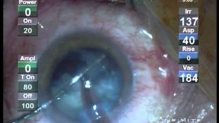 Operatie Cataracta Prof Dr Dorin Chiselita  Clinica Oftaprof [upl. by Ahsinet288]