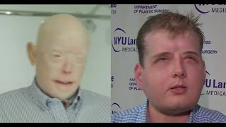 Burned Firefighter Receives Face Transplant [upl. by Enois]