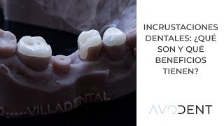 ¿Qué son las incrustaciones dentales y qué beneficios tienen  Clínica dental Avodent [upl. by Assira]