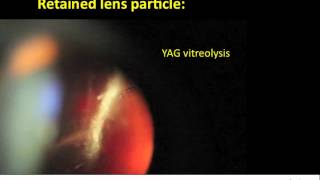 YAG vitreolysis for retained lens particle after cataract surgery [upl. by Htims]