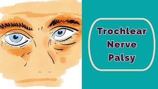 Trochlear Nerve Palsy Rapid Review [upl. by Tebzil]