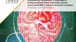 Therapeutic Challenges in Subependymal Giant Cell Astrocytoma Associated With Tuberous Sclerosis [upl. by Sollie]