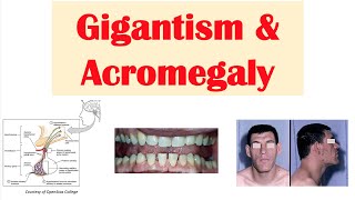 Gigantism amp Acromegaly  Growth Hormone Signs amp Symptoms Diagnosis Treatment [upl. by Dennet]