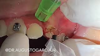 Gengivecotmia gengivoplastia com bisturi elétrico Gengivoplasty gengivectomy with Eletric bisturi [upl. by Igic]