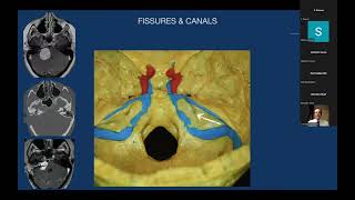 Anatomy and Surgical Approaches to Petrous Bone  Professor Pablo Gonzalez [upl. by Nerred]