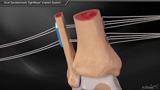 Dual Syndesmosis TightRope Implant System [upl. by Troc]