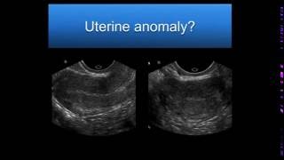 AIUM Webinar Problem Solving with 3D Sonography of the Uterus and Adnexa [upl. by Kcirdderf]