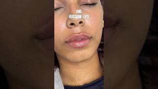 1ML RUSSIAN LIP FILLER russianlips lipfiller lipfillers lipfillerinjections lipfillerresults [upl. by Adlaremse]