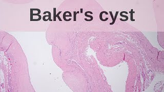 What is a Bakers Cyst  Pathology mini tutorials [upl. by Max784]