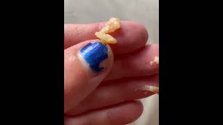 healing fungus mold skin morgellons disease alien implant health help faith raredisease [upl. by Aihsenek]