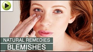 Skin Care  Clearing Skin Blemishes  Natural Ayurvedic Home Remedies [upl. by Neitsirhc]