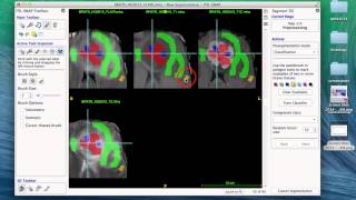 Tumor segmentation in ITKSNAP 32 [upl. by Gayler240]