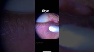 Eyelid Stye expression and treatment [upl. by Enyar496]