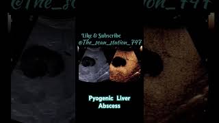 Pyogenic Liver Abscess doctor baby abdomen usg pregnant pregnancyjourney education [upl. by Inatirb]