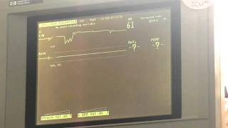 ECG WAVEFORMS [upl. by Ahsha]