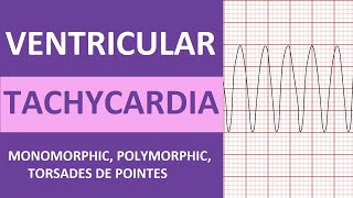 Ventricular Tachycardia Vtach ECG Interpretation Treatment Nursing NCLEX Review [upl. by Ojyram]