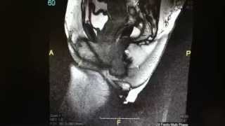 Magnetic Resonance Defecography Rectocele Cystocele [upl. by Yliab634]