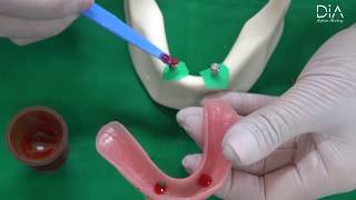 Dental Implant education video overdenture part [upl. by Anairdna]