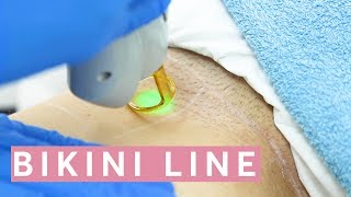 Laser Hair Removal Bikini THIS is how it works [upl. by Schuler]